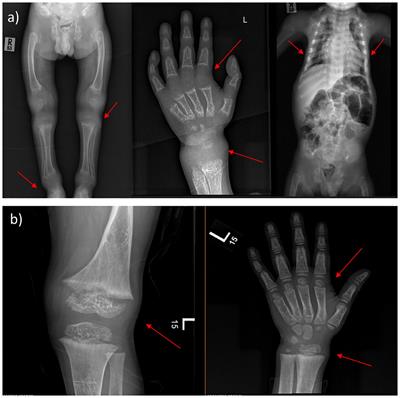 Clinical characteristics and long-term management for patients with vitamin D-dependent rickets type II: a retrospective study at a single center in Saudi Arabia
